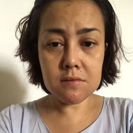 5 Potret Rency Milano Yang Alami Malpraktik Klinik Kesehatan Dagu Sampai Keluarkan Nanah Kapanlagi Com