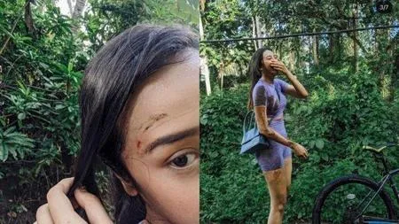 6 Selebriti Ini Pernah Terlibat Kecelakaan Sepeda & Motor, Ada yang Dahinya Sampai Sobek!