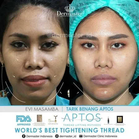 9 Potret Sebelum & Sesudah Para Penyanyi Ini Lakukan Tanam Benang, Pipi Makin Tirus - Pede Bertambah
