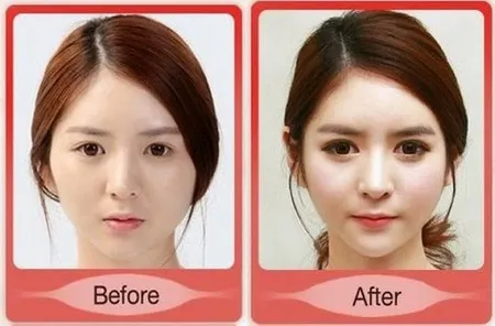 Foto Before After Oplas Orang Korea Hasilnya Bikin Melongo M Kapanlagi Com