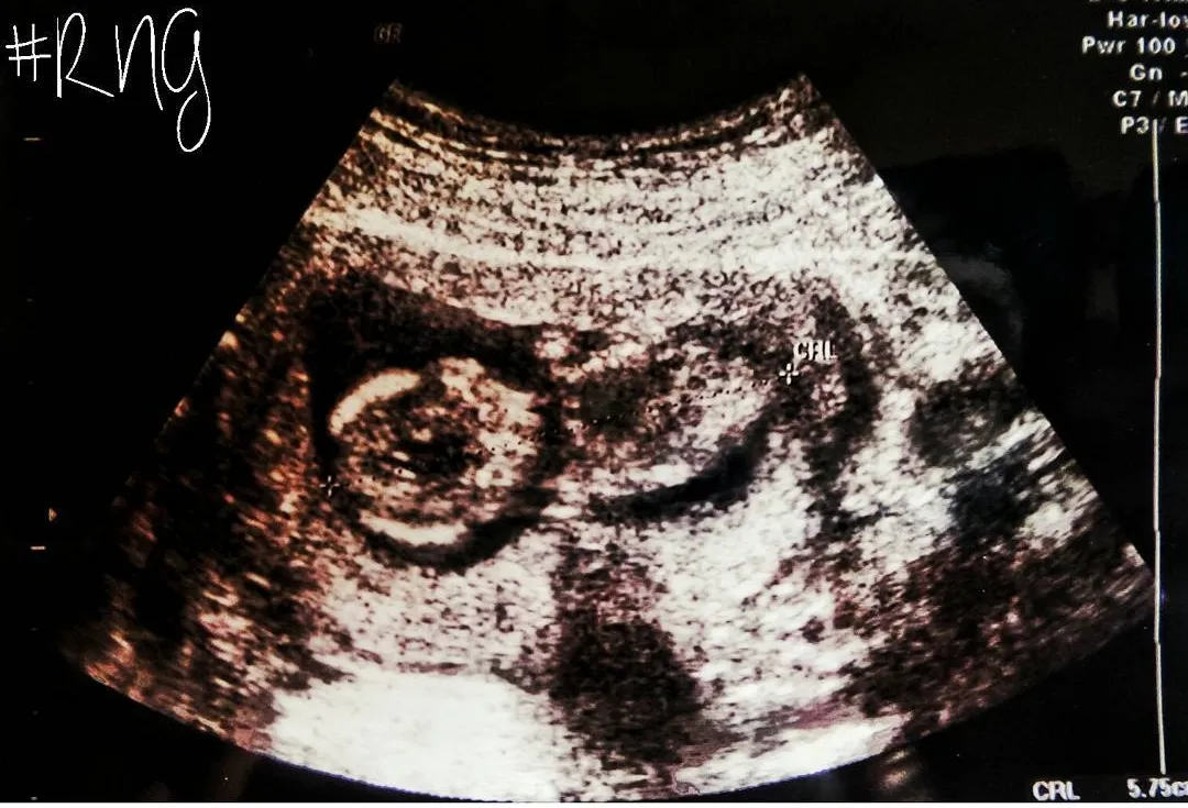 USG gambar kandungan Nycta © Instagram/missnyctagina