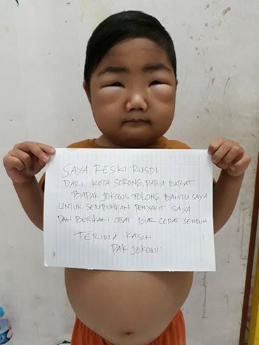 Reski Rusdi, bocah penderita sindrom nefrotik yang jadi viral setelah videonya diunggah ke Facebook © Facebook.com/Abdul Rochman Akhyar