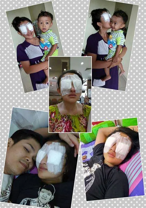 Seorang Ibu hampir kehilangan penglihatan karena penggunaan soft lens © Facebook.com/Intan Xiuzhee