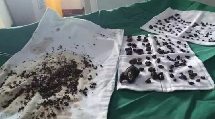 Seorang wanita di China harus menjalani operasi besar untuk mengeluarkan 200 batu dalam tubuhnya © odditycentral