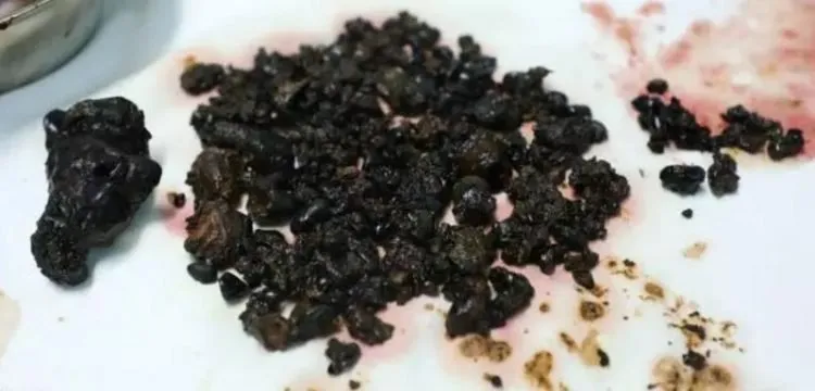 Menurut dokter yang menangani pasien, kebiasaan jarang sarapan disinyalir membantuk batu ginjal sebanyak ini © odditycentral