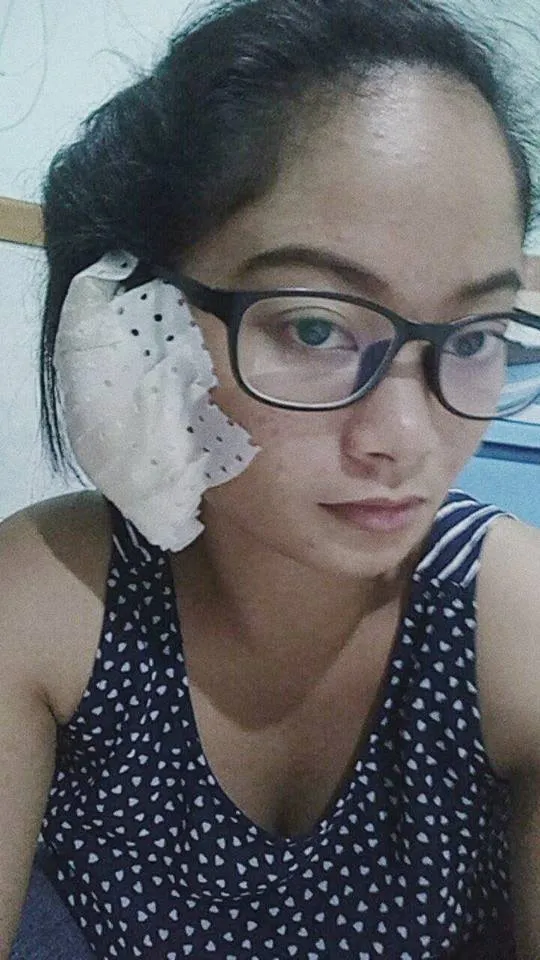 Karena anting-anting tersebut tak bisa dilepaskan, Elace mengalami infeksi dan harus menjalani operasi © Facebook.com/Elace Batula
