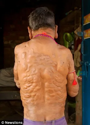 Mithun Chauhan, menderita neurofibroma yakni tumor yang tumbuh di bagian syaraf © dailymail.co.uk