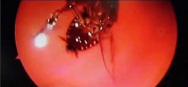 Butuh waktu 45 menit untuk mengeluarkan kecoa dari dalam otak Selvi © metro.co.uk