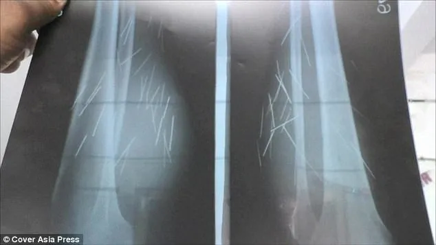 Hasil X-ray Devi © Daily Mail