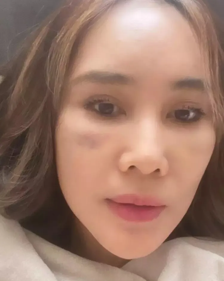 Potret terbaru Ina Thomas usai jalani operasi plastik di Korea Selatan (Sumber: Instagram/@inathomas)