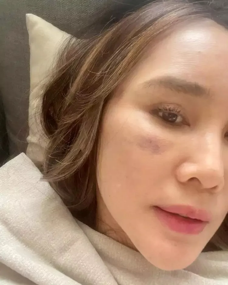 Potret terbaru Ina Thomas usai jalani operasi plastik di Korea Selatan (Sumber: Instagram/@inathomas)