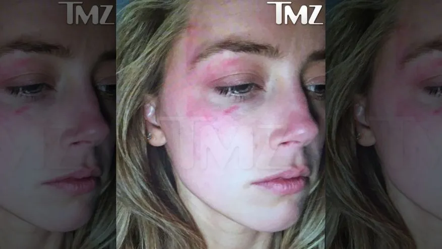 Luka Memar Amber Heard © TMZ