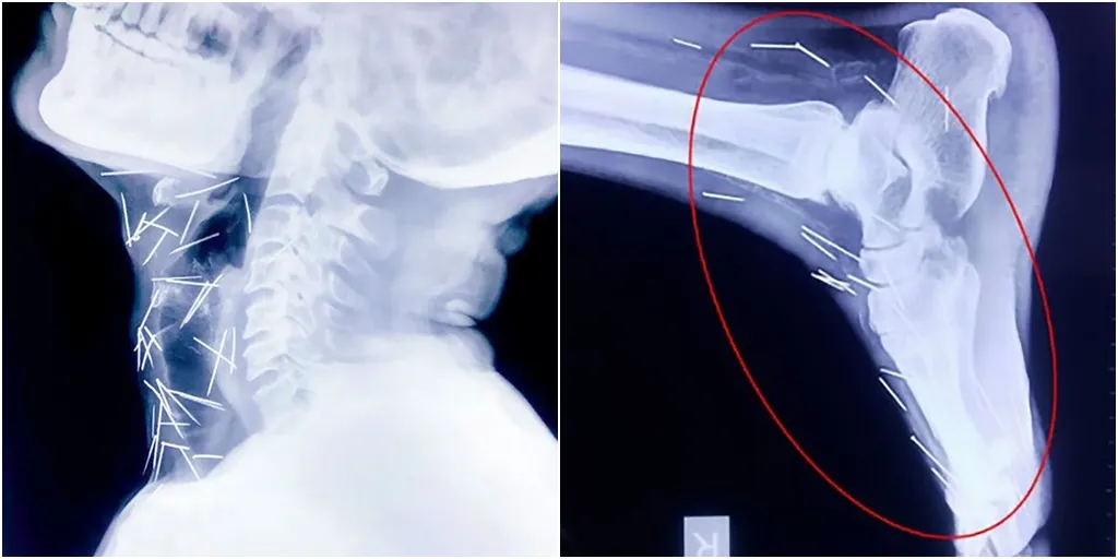 Di dalam tubuh Badrilal ditemukan 75 jarum dan paku © mirror.co.uk