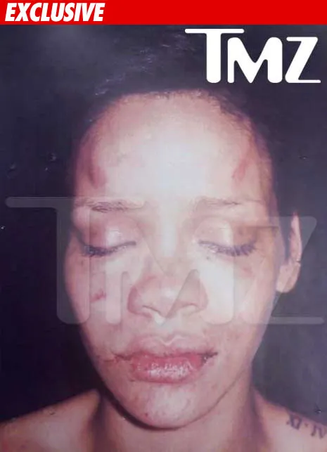 Foto Rihanna setelah alami penganiayaan © TMZ