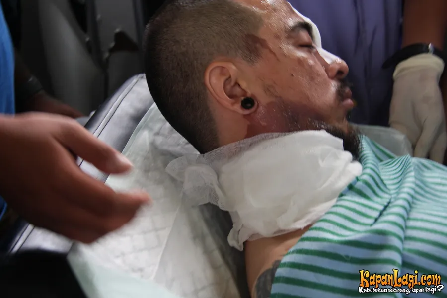 Kondisi luka bakar di wajah Beery saat keluar dari UGD RSSA Malang