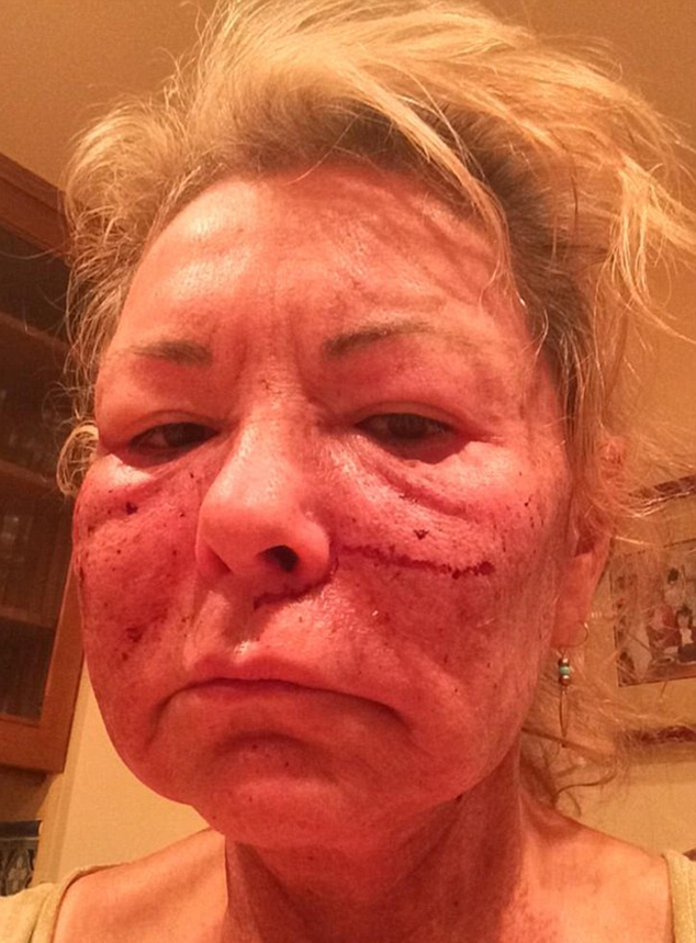 Wajah babak belur Roseanne bukan karena Cosby @ twitter.com/therealroseanne