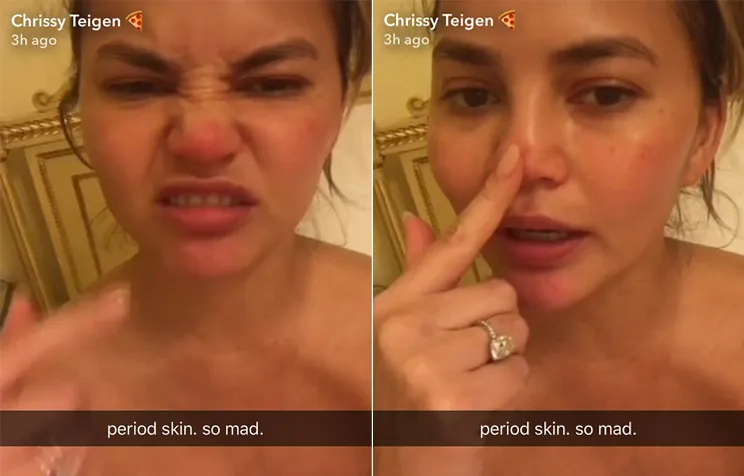 Chrissy pamer wajah penuh jerawat © Chrissy's Snapchat