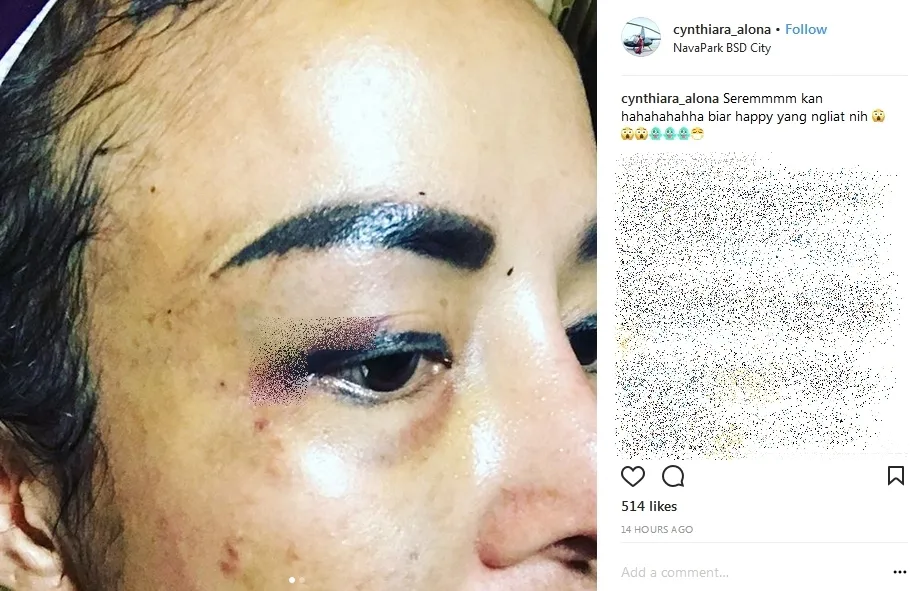 Cynthiara Alona jadi korban penganiayaan kekasih ©instagram/cynthiara_alona