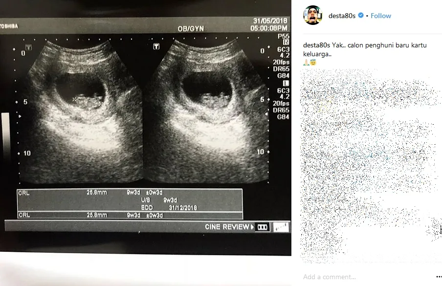 Desta umumkan kehamilan Natasha lewat Instagram ©desta08