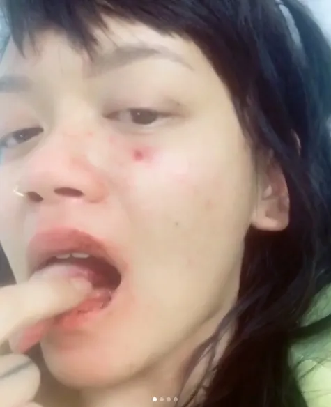 Lidah Dylan terpotong karena kekerasan yang ia alami ©instagram/dylan_sada