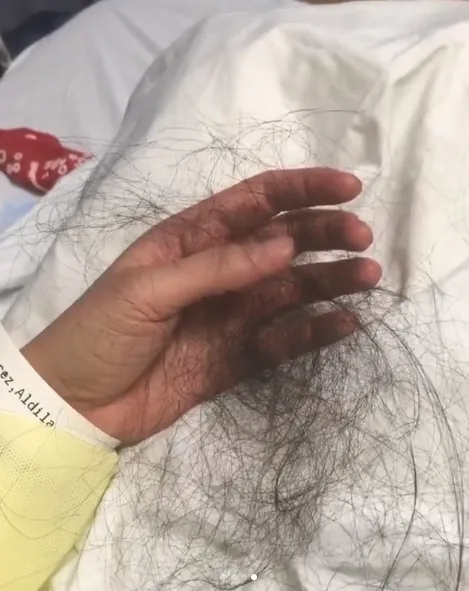 Rambut Dylan yang rontok parah setelah mendapatkan kekerasan dari pasangan ©instagram/dylan_sada