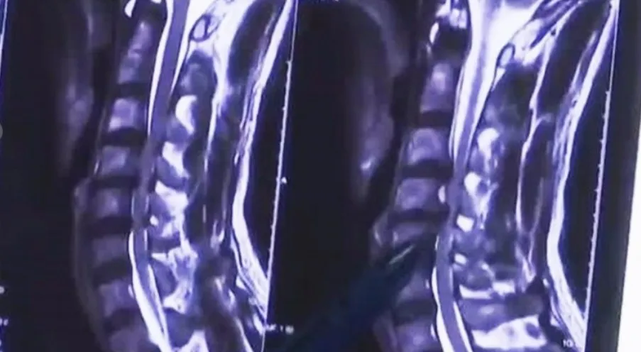 X-Ray Tulang Belakang Li © Worldofbuzz