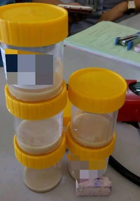 Cairan nanah yang dikeluarkan dari paru-paru Ali © Facebook.com/Mohd Syamirulah Rahim