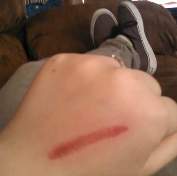 Salah satu bekas luka yang disebabkan oleh eraser challenge © instagram.com/alexisjones63