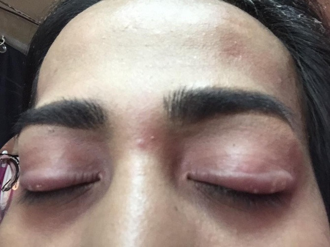 Kondisi mata Zaira setelah terkena efek pemakaian eyeliner abal-abal (© Brilio)