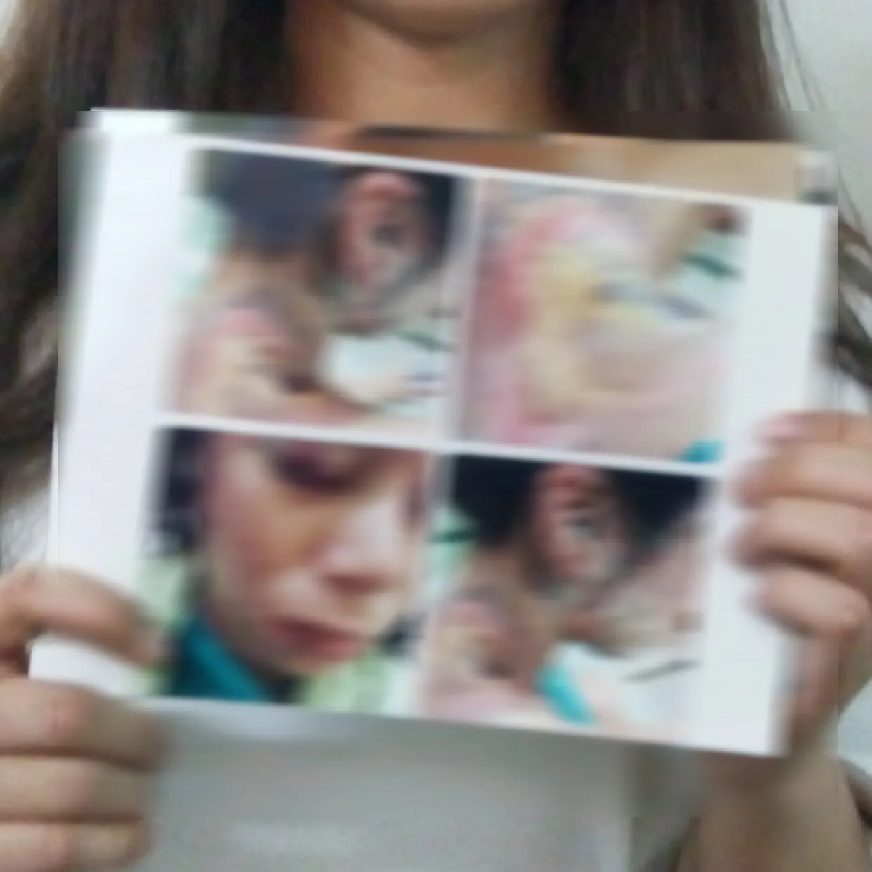 Inilah luka akibat air keras yang disiramkan pada Fabioli (gambar sedikit kami blur untuk kenyamanan pembaca) ©KapanLagi.com / Abbas Aditya