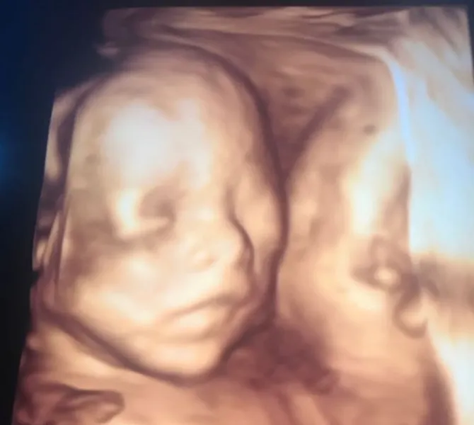 Hasil USG Fairuz terlihat sangat jelas. © Instagram/fairuzarafiq