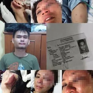 Kondisi Farah adik Fadlan usai penganiayaan/©Istimewa