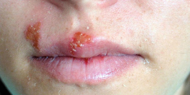 10 Natural Ways to Treat Herpes, One of Them Using Cornstarch