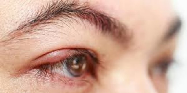 10 Natural, Effective, and Simple Ways to Treat Styes