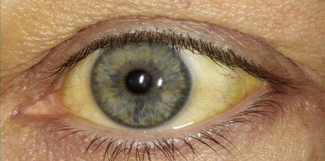 What causes yellow eyes