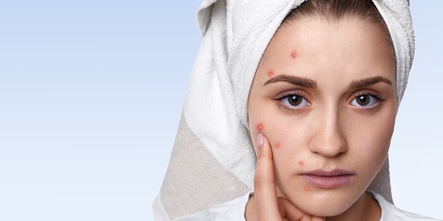 11 Ways to Get Rid of Inflamed Acne, Easy and Without Medication