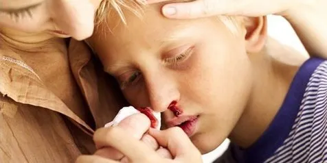 8 Cara Mengatasi Mimisan dengan Cepat dan Mudah, Salah Satunya Gunakan Air Garam
