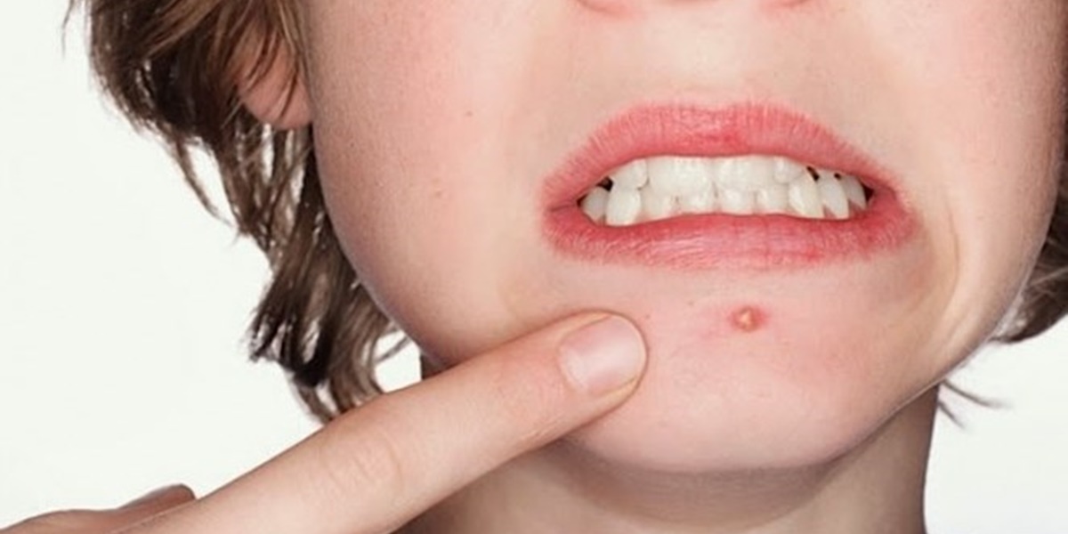 6 Meanings of Pimples Below the Lips According to Javanese Beliefs, Not Always a Bad Sign