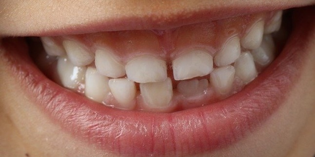 7 Ways to Naturally Treat Swollen Gums, Easy and Can Be Done Yourself