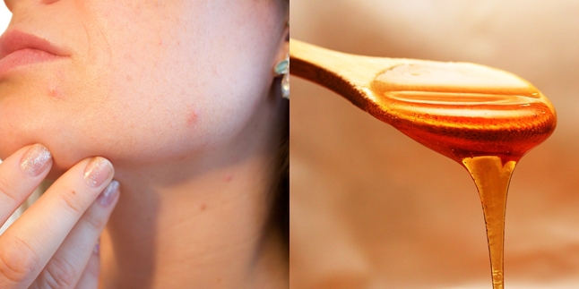 7 Natural Ways to Remove Chickenpox Scars