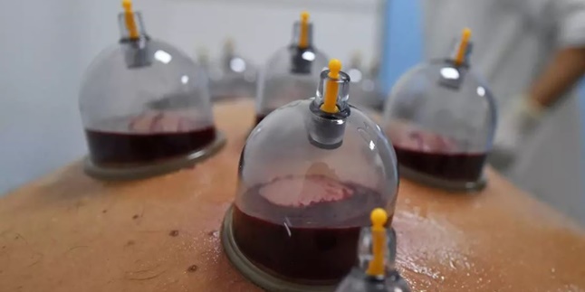 7 Benefits of Cupping for the Body, Removing Toxins - Improving Blood Circulation