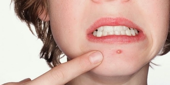 8 Ways to Reduce Swollen Acne Overnight, Easy to Do!