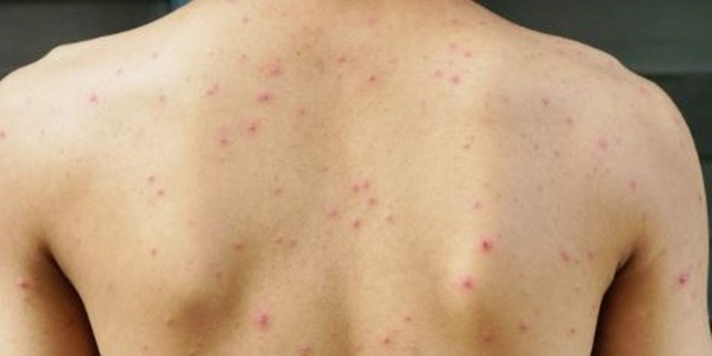 8 Ways to Get Rid of Back Acne, Know the Causes and How to Treat Them