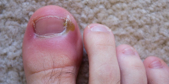 8 Natural Ways to Treat Ingrown Nails, Know the Causes