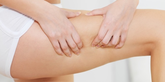 9 Causes of Cellulite That Often Occur, Beware of Certain Habits