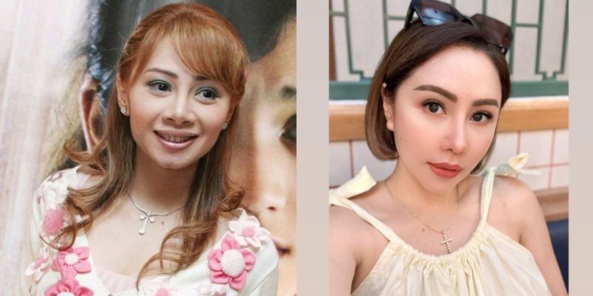 9 Artists' Transformations Before and After Chin Fillers, Faces Become Slimmer and Stunning