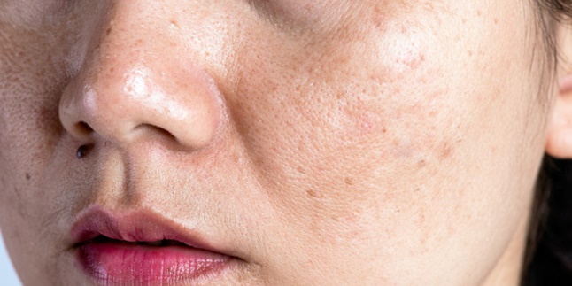 Can Cause Acne, Here Are 5 Ways to Naturally Overcome Clogged Pores