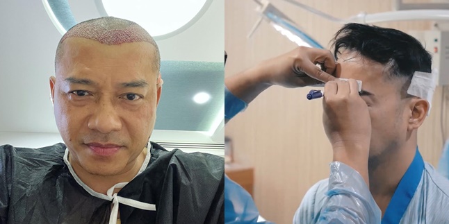 Not Only Anang Hermansyah, These Celebrities Have Also Undergone Hair Transplantation - The Results Are Attention-Grabbing