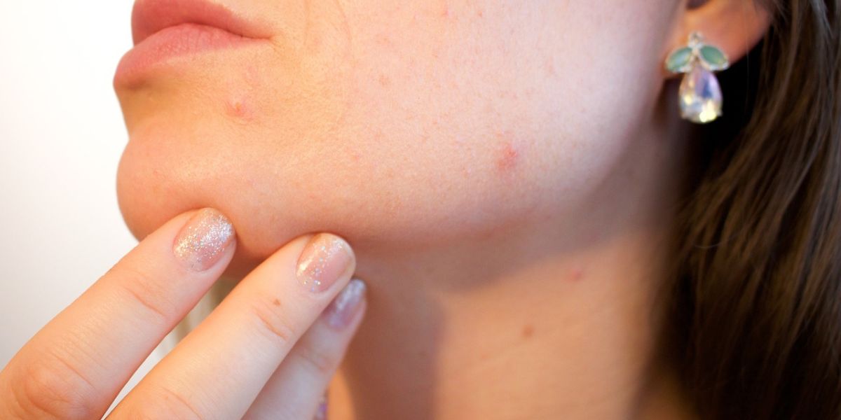 Powerful Ways to Remove Acne Scars for Increased Confidence, Without Side Effects