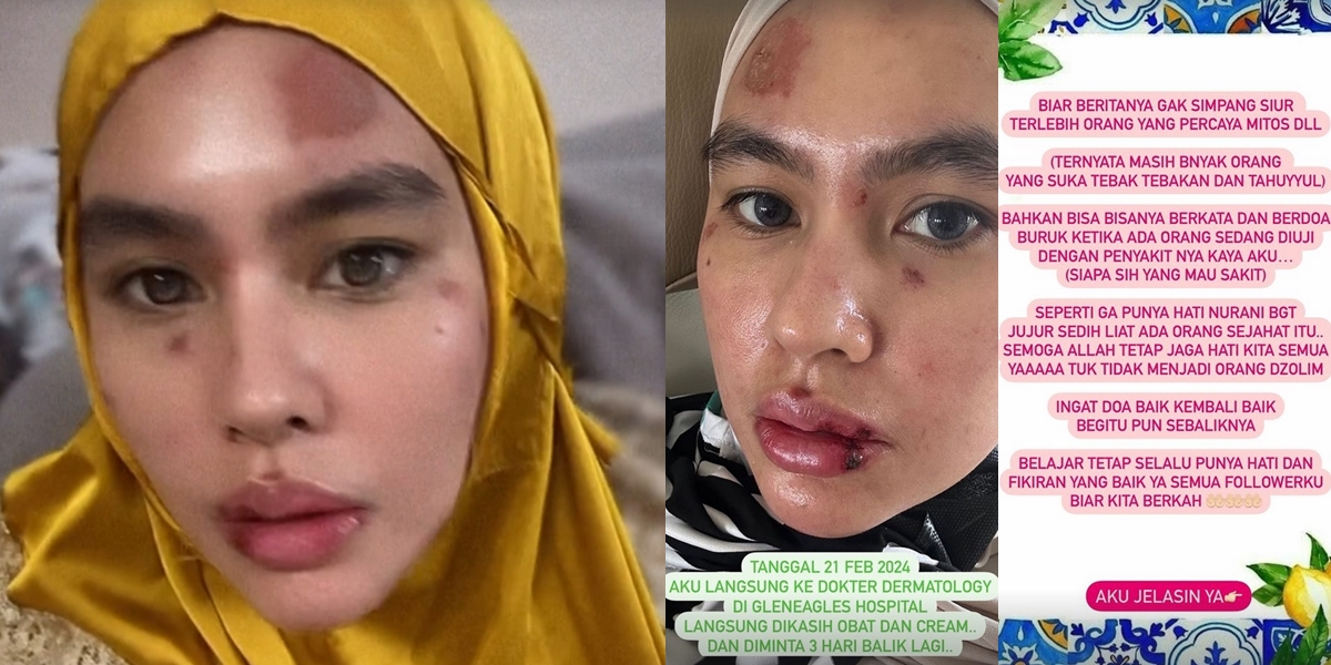 Called Karma, 8 Portraits of the Causes of Kartika Putri's Blistered Face Revealed - Responds to Sarcastic Comments from Netizens